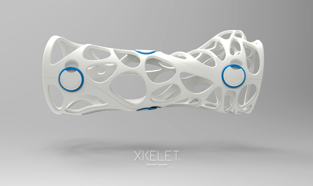 A 3-D-printed cast designed by Xkelet.