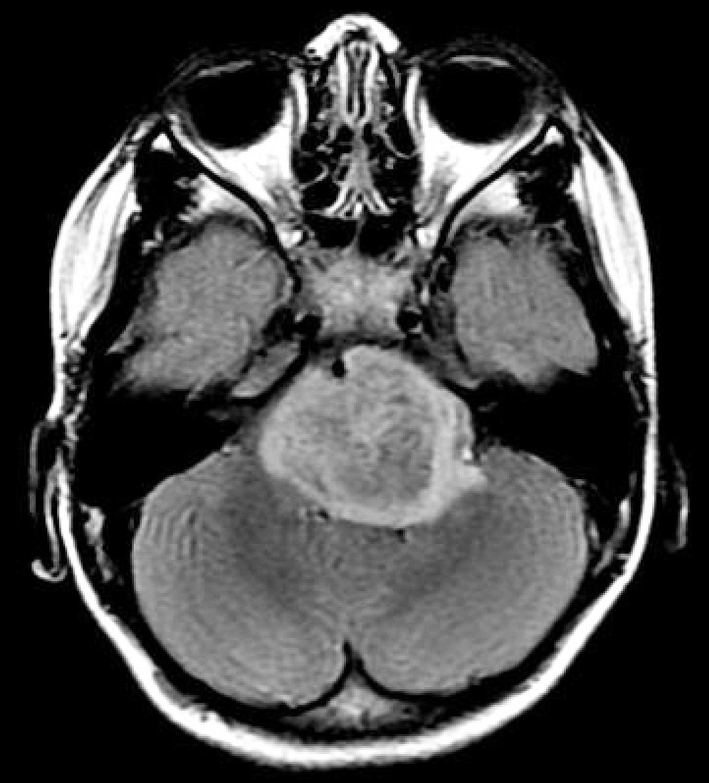 Genomic testing of pediatric brain tumor samples may help guide diagnosis and treatment.