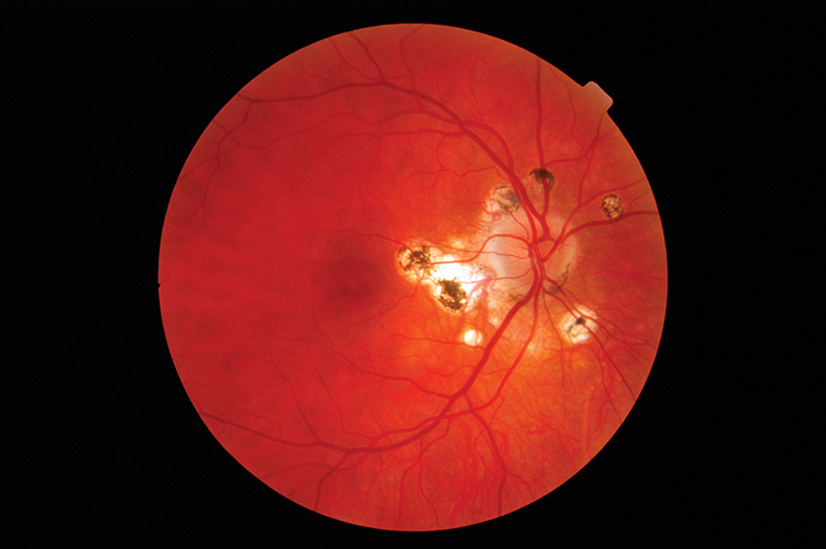 2007-2008 Patients with an inherited retinal disease called Leber’s congenital amaurosis appear to have improved vision after treatment with a gene therapy. However, years later, researchers will report in the <i>New England Journal of Medicine</i> that some patients’ eyesight has begun to wane.