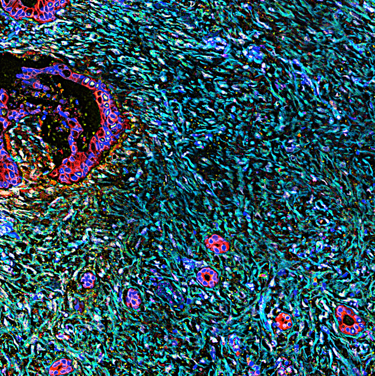 Pancreatic tumor cells under a microscope.