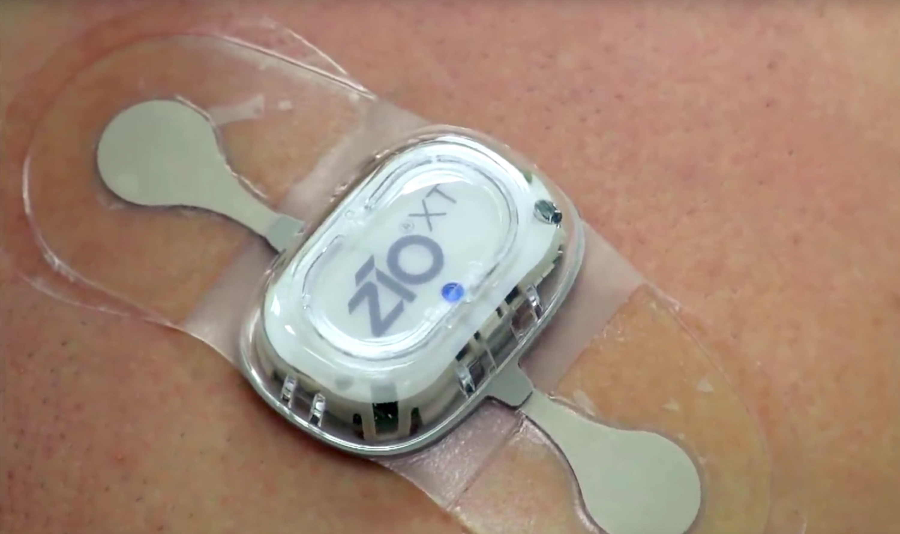 Researchers used portable ECG devices to collect 30,000 30-second clips from patients with varying forms of arrhythmia.