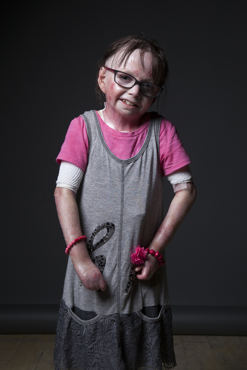 A girl with epidermolysis bullosa.