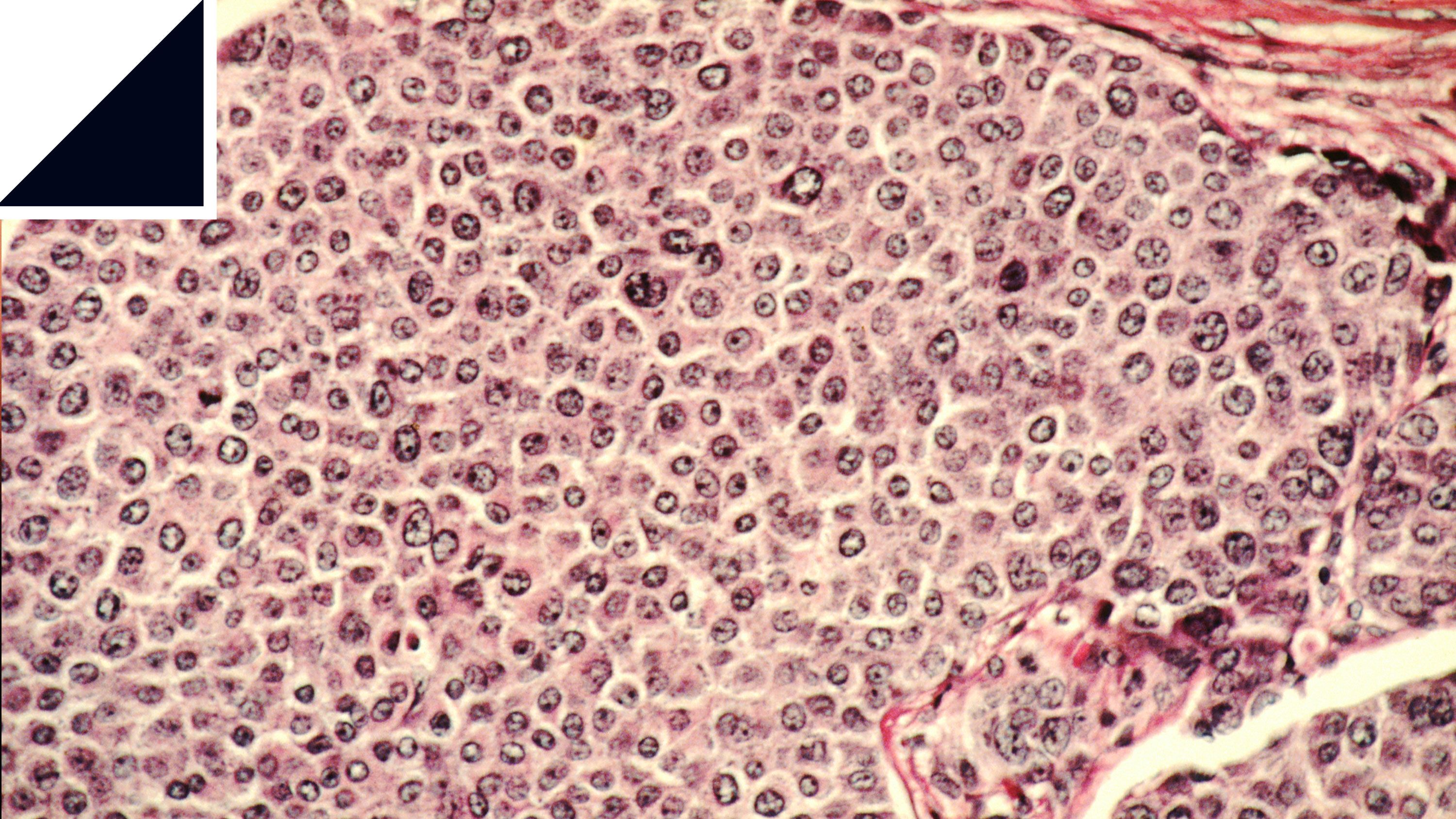 ナノ粒子でがん細胞を直接攻撃、再発防止へ新治療法