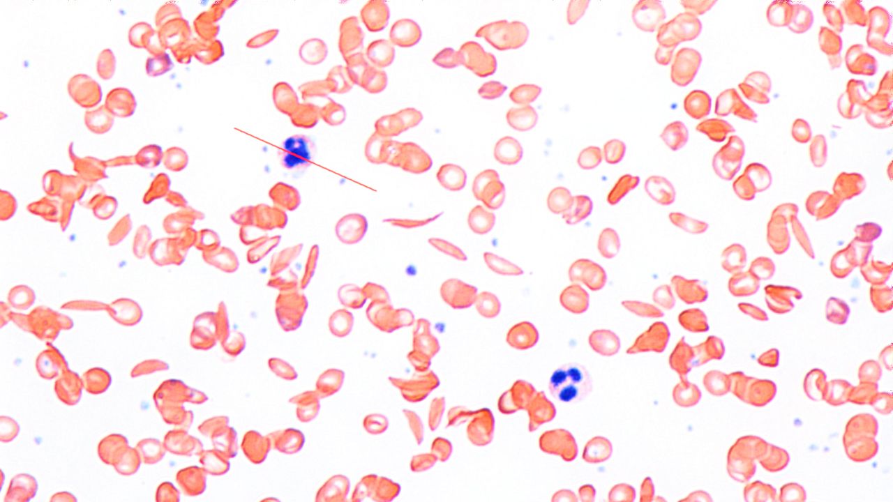 CRISPR遺伝子療法は「現実の患者」を救えるのか？