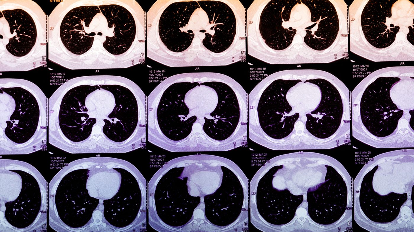 MIT Tech Review: 心筋梗塞の兆候を自動検出、AIが病気を定義する時代